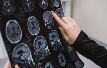 التغيرات الدماغية في مرض ألزهايمر تختلف حسب الجنس